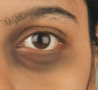 Before-