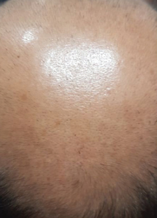Before-