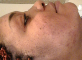After-Aesthet Xpertpeel