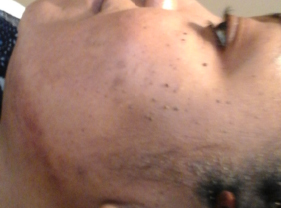 After-Aesthet Xpertpeel