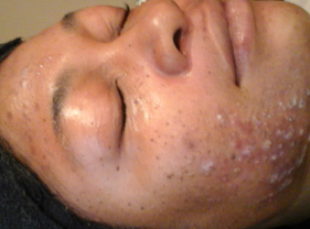 Before-Aesthet Xpertpeel