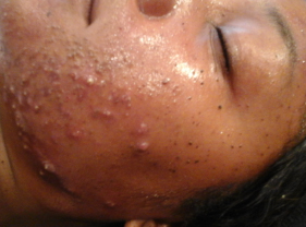 Before-Aesthet Xpertpeel