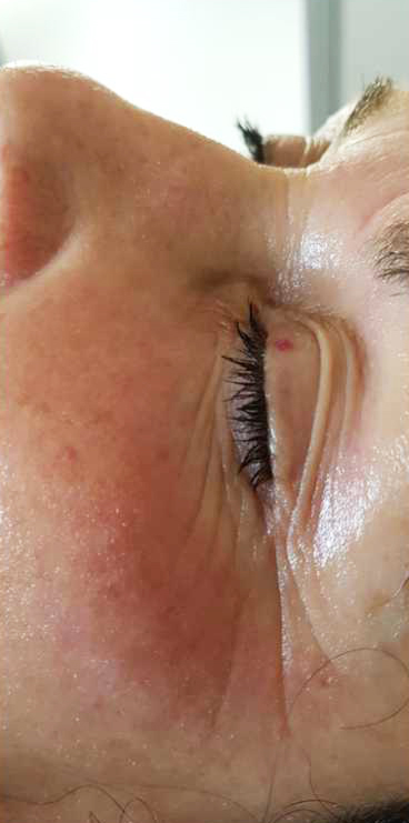 After-Aesthet Reticulated HA MesoFiller