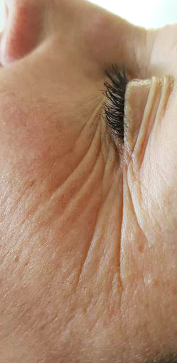 Before-Aesthet Reticulated HA MesoFiller