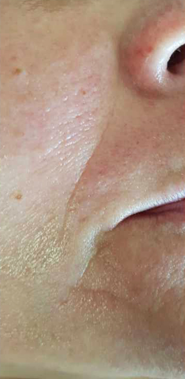 After-Aesthet Reticulated HA MesoFiller