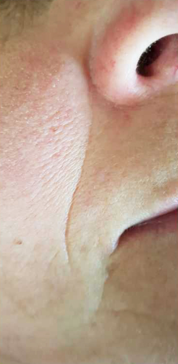 Before-Aesthet Reticulated HA MesoFiller