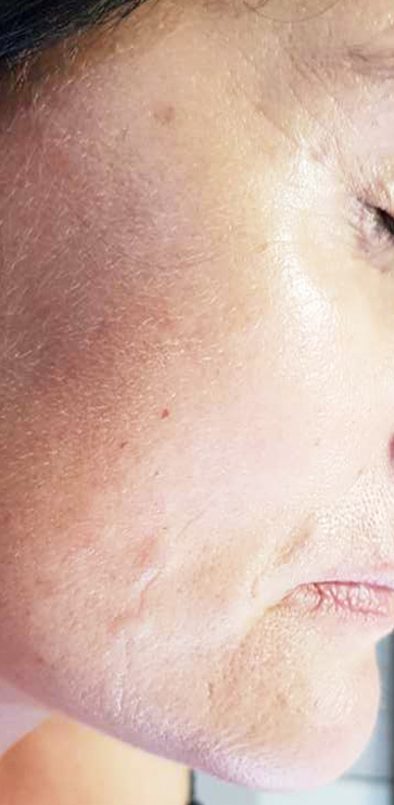 After-Aesthet Reticulated HA MesoFiller