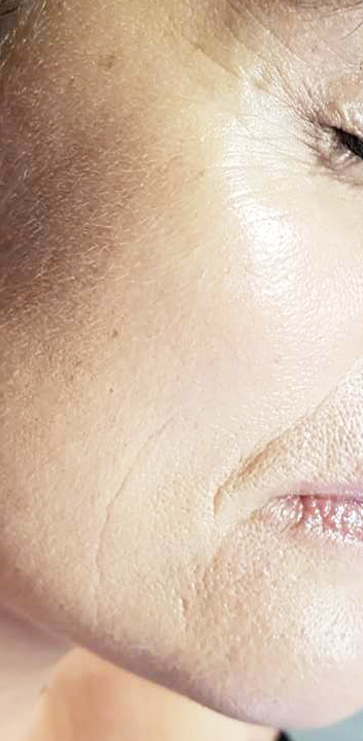 Before-Aesthet Reticulated HA MesoFiller