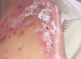 Before-Aesthet Recovery treatment