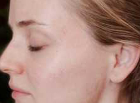 After-Aesthet Xpertpeel