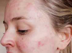 Before-Aesthet Xpertpeel