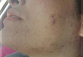After-Aesthet Keratopeel