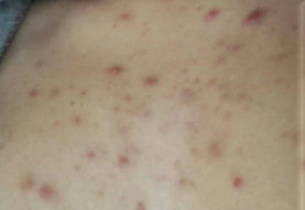 Before-Aesthet Keratopeel