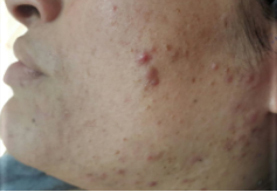 Before-Aesthet Keratopeel