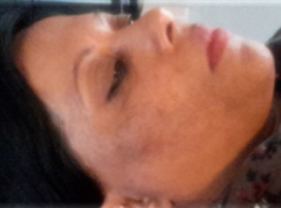 After-Aesthet Xpert peel