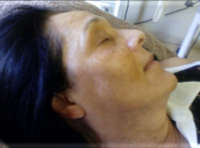 After-Aesthet Xpert Peel