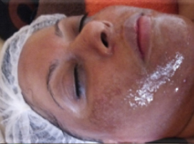 Before-Aesthet Xpert peel