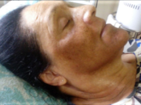 Before-Aesthet Xpert Peel