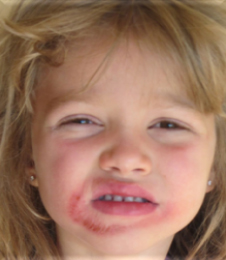 Before-HK eczema