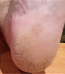 Before- HumanKind footpeel