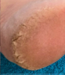 Before-HumanKind Tissue Oil