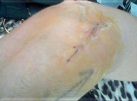Before-HumanKind Tissue Oil