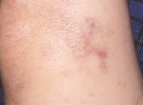 After-Aesthet Recovery treatment