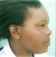 After-Dermaplex Pigmentation