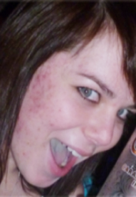 Before-Dermaplex acne